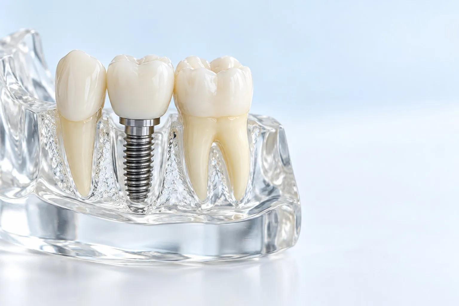 Şeffaf çene modelinde iki doğal diş arasında, üzerine kuron takılmış implant